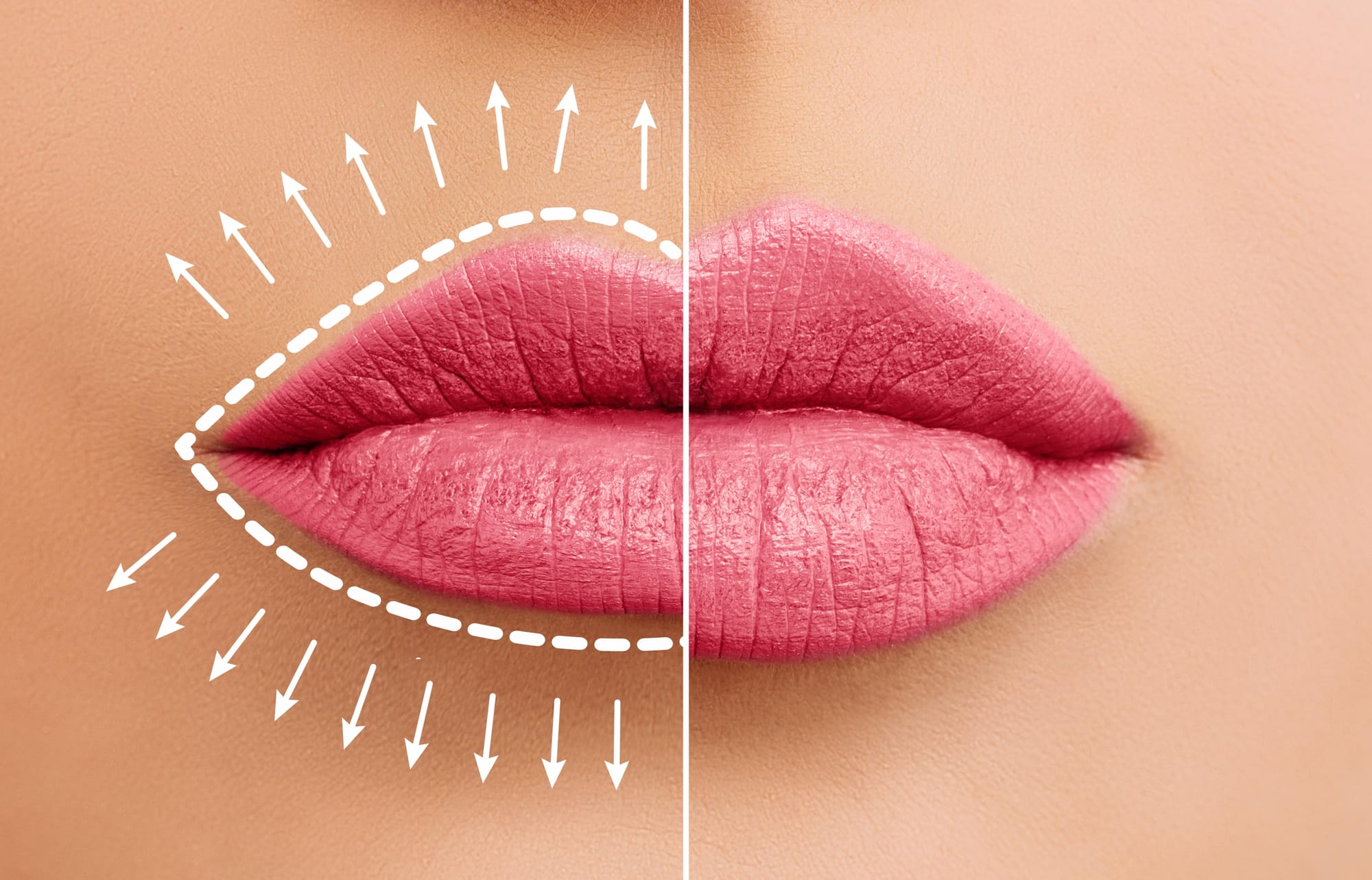 Lip Filler Swelling Timeline: What to Expect and Aftercare